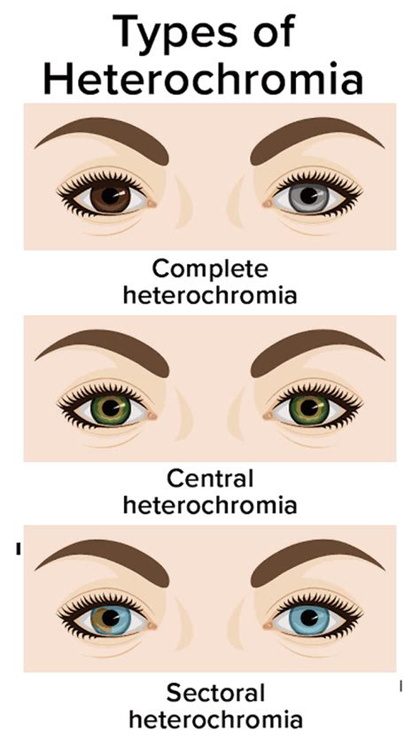 heterochromia pinay|Don't it make my blue eyes brown: heterochromia and other .